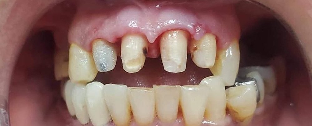 تجميل الأسنان الأمامية بالتيجان