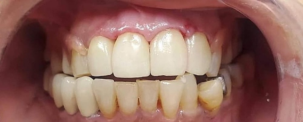 تجميل الأسنان الأمامية بالتيجان