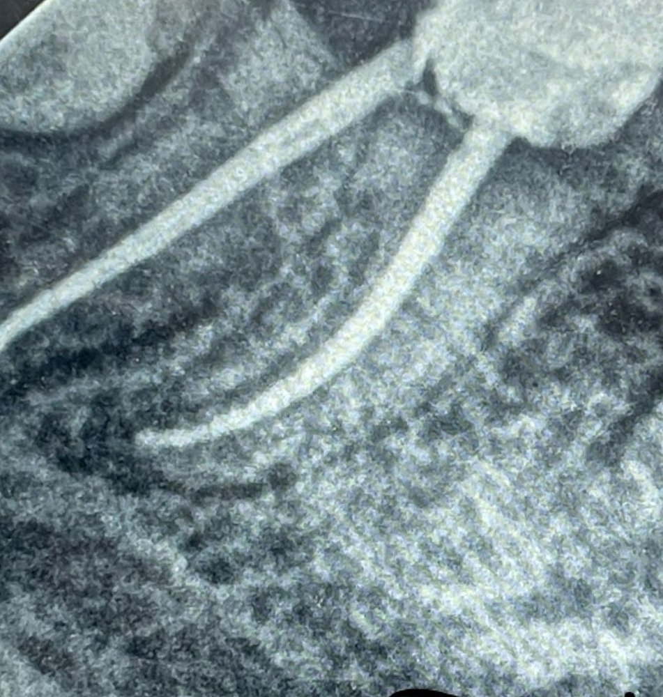 علاج عصب لضرس بقنوات منحنية